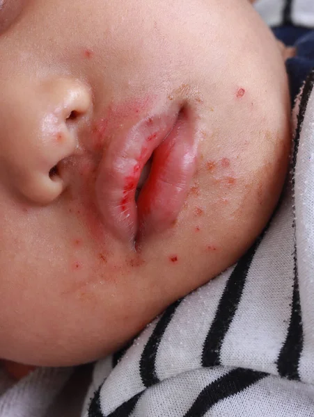 Bumps Vermelhos Boca Dermatite Facial Mão Erupção Cutânea Doença Boca — Fotografia de Stock