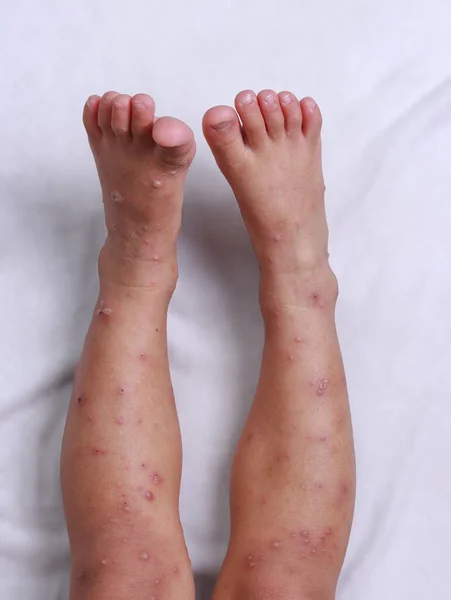 Sarpullido Por Virus Hfmd Ambas Piernas Niño Dolor Tratamiento Médico —  Fotos de Stock