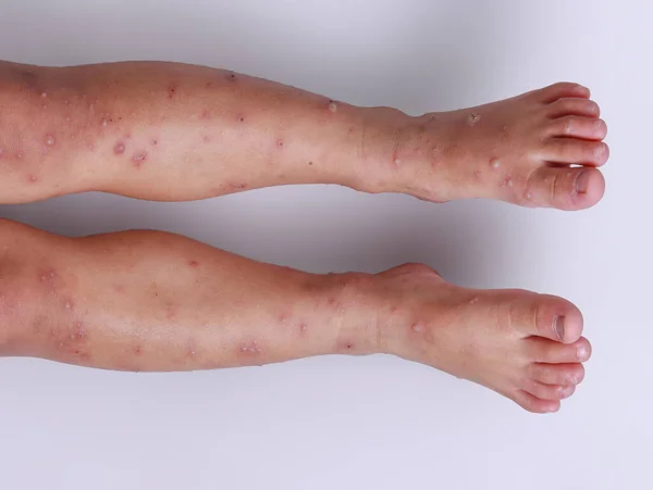 Hfmd Ręka Stopa Wirus Czerwonych Pęcherzy Kolanach Epidemia Nogi Chorym — Zdjęcie stockowe
