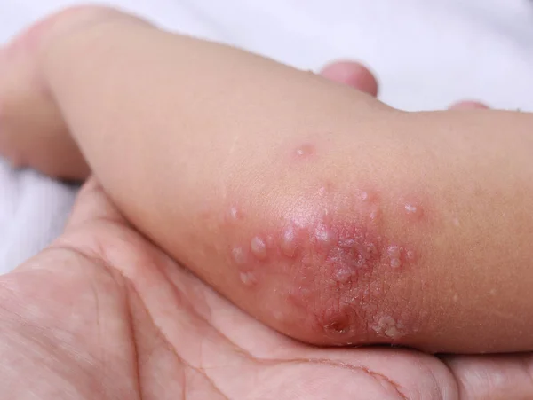 구제역의 팔꿈치에 Hfmd 바이러스 상처입니다 일반적으로 장마철에 생기는 풍진이다 스톡 사진