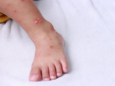 Asyalı çocuk ayak kabarcığı virüsü HFMD enfeksiyonu cilt ağrısı, su çiçeği