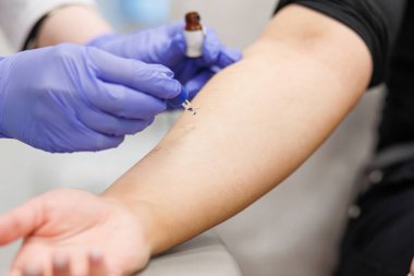 Bir tıp kliniğinde alerji testi sırasında hastanın koluna alerji damlası uygulayan bir doktor. Yüksek kalite fotoğraf. Yakın çekim.
