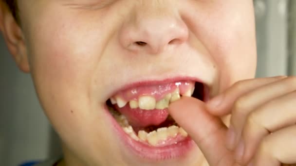 Ребенок Трясет Пальцем Молочного Зуба Рот Открыт Другие Зубы Видны — стоковое видео
