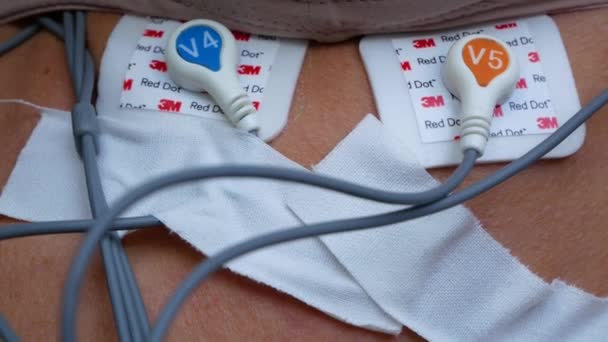 Kharkiv Ukraina Januari 2022 Holter Hjärtapparat Patientens Kropp Övervakning Dygnet — Stockvideo