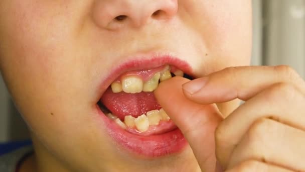 Uma Criança Sacode Dente Leite Dentes Permanentes São Visíveis Cima — Vídeo de Stock