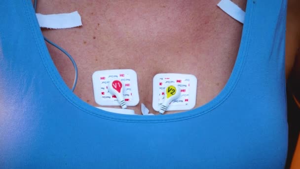 胸に心臓機能を毎日のモニタリングするためのデバイスを持つ認識できない女性 ハルター 心臓病の診断について エレクトロカーディオグラムの毎日のモニタリング — ストック動画