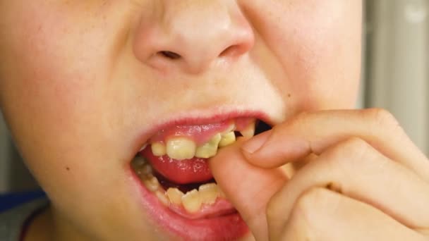 Хлопчик Вішає Дитячий Зуб Руками Крупним Планом Заміна Зубів Дітей — стокове відео