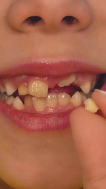 Çocuk yeni düşmüş süt dişini ağzının karşısında tutuyor. Çocuk, bebek dişinin düştüğü yeri gösteriyor. Çocuklarda diş değişimi. Diş bakımı ve ağız boşluğu. Pediyatrik Dişçilik