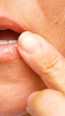 Kız dudağına uçuk merhemi sürüyor. Yakın plan. Dudaklarda uçuk tedavisi var. Dudaklardaki uçuklar için merhem ve kremler