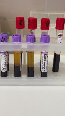 Tıbbi bir laboratuarda analiz için bir sürü etiketli kan tüpü. Hastaların teşhisini belirlemek için kan testleri..