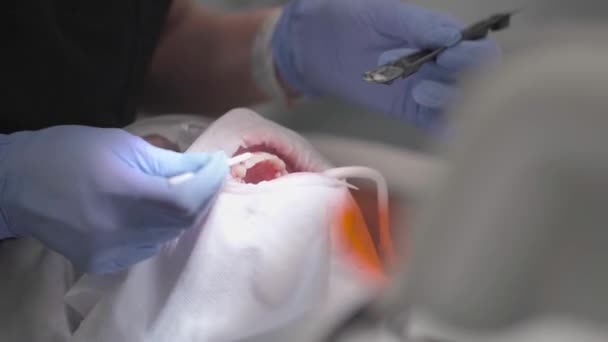 Dentista Aplica Barniz Fluoruro Los Dientes Del Paciente Con Cepillo — Vídeo de stock