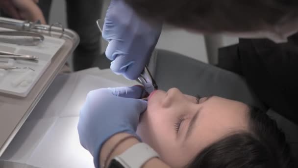 Pediatric Dental Surgeon Loosens Removes Baby Tooth Forceps Local Anesthesia — Stock Video