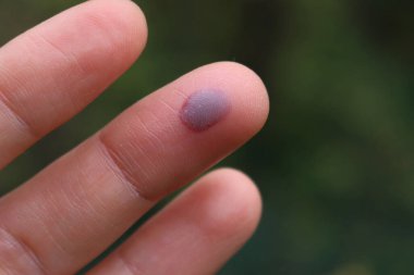 Yeşil çayır arka planında yaralanma nedeniyle dişi bir yetişkinin parmağında küçük mor bir hematom var.