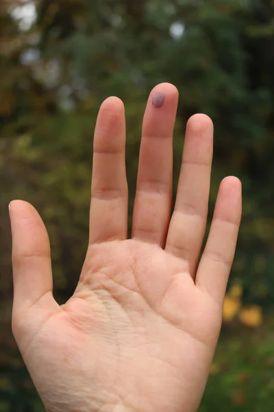 Крупный План Маленькой Фиолетовой Гематомы Пальце Взрослой Женщины Травмы Зеленом — стоковое фото