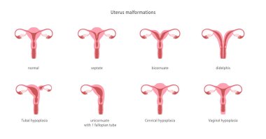 İnsan rahim malformasyonları. Bir takım tıbbi çizelgeler. Vektör illüstrasyonu