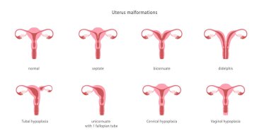 Human uterine malformations. Set of medical charts. Vector illustration clipart
