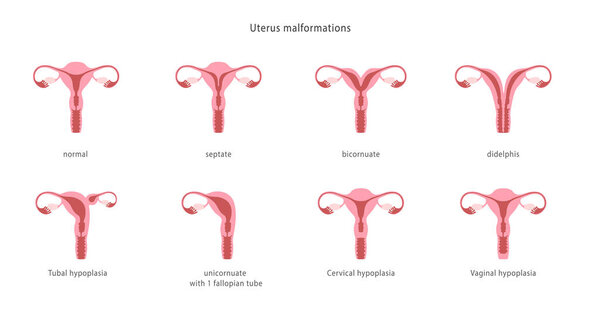 Human uterine malformations. Set of medical charts. Vector illustration
