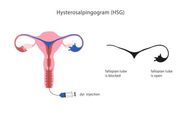 Rahim borusu tıkanıklığının histerosalpingogram klinik testi. - Evet. Vektör illüstrasyonu