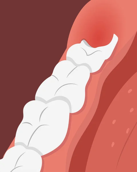 Illustration Einer Zahnreihe Mit Entzündetem Zahnfleisch Über Dem Wachsenden Weisheitszahn — Stockvektor