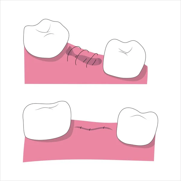 不健康な歯抽出プロセス医療イラスト ベクターイラスト — ストックベクタ