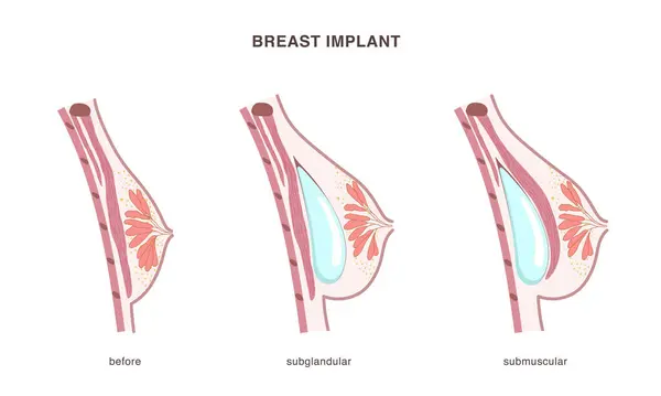 stock vector Silicone implant placement under the gland and muscle in female breast. Side view cross section of before and after operation. Flat style chart. Vector illustration