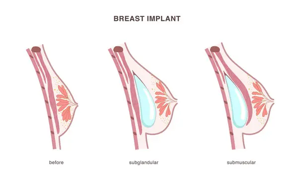 Salgı bezinin altına silikon yerleştirilmiş ve kadın göğsüne kas yerleştirilmiş. Operasyon öncesi ve sonrası yan görüş kesiti. Düz stil çizelgesi. Vektör illüstrasyonu