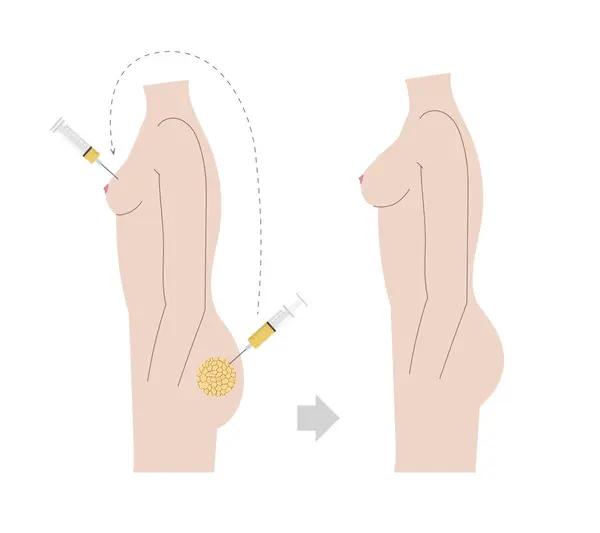 Diğer vücut parçalarından göğse yağ ile doğal göğüs büyütme. Çıplak vücut görüntüsü üzerinde önce ve sonra oluşan yağ dokusu çizimi... vektör illüstrasyonu