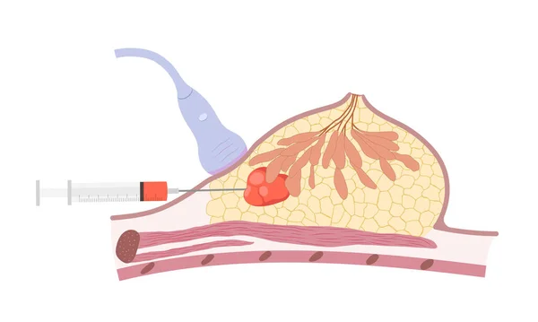유방암 생검을 뚱뚱한 조직에 낭종을 유방의 단면도 일러스트 로열티 프리 스톡 벡터