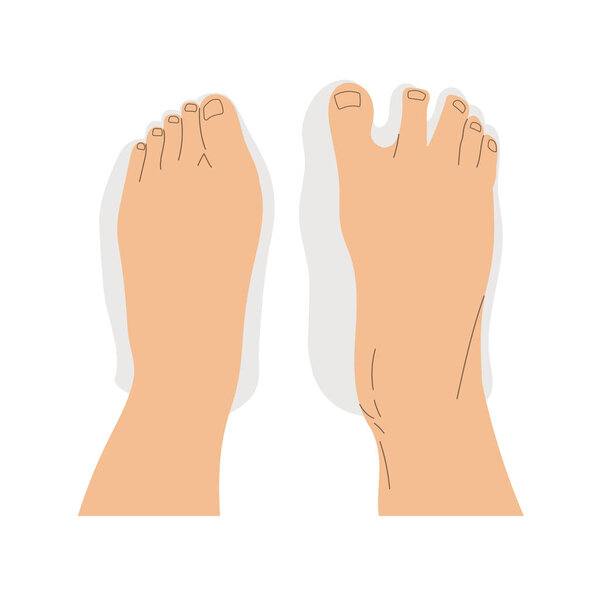 Top view comparison of healthy and deformed feet after wearing regular and barefoot shoes. Vector illustration