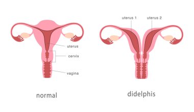 Didelphis ve normal insan rahim yapısı. Rahim derinliği, doğuştan gelen uterus malformasyonu. Anatomi çizelgesi. Vektör illüstrasyonu