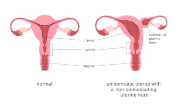 Normal insan rahmi ve tek boynuzlu uterus ile iletişim kuramayan rahim boynuzu. Doğuştan rahim malformasyonu diyagramı. Vektör illüstrasyonu