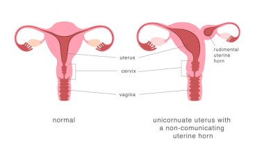 Normal human uterus and unicornuate uterus with non-comunicating uterine horn. Congenital uterine malformation anatomy diagram. Vector illustration clipart