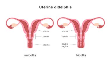 Didelphis insan rahim yapısı unicollis ve bicollis tipi. Rahim derinliği, doğuştan gelen uterus malformasyonu. Anatomi çizelgesi. Vektör illüstrasyonu