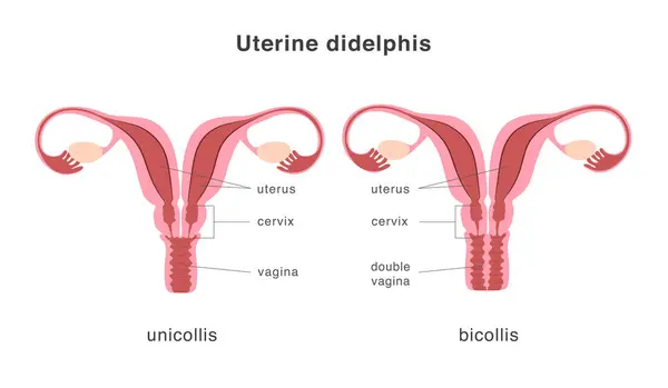 Didelphis 유니콜리스와 유형의 자궁의 잘못된 형성으로서의 극심한 중성미자입니다 해부학 일러스트 벡터 그래픽