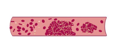 Arterde tromboembolizmin tıbbi histolojik çizelgesi. Vektör illüstrasyonu