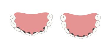 Lingual braces in the mouth at the inner surface of tooth before and after chart. Medical simple flat geometric picture. Vector illustration clipart