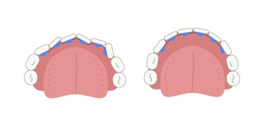 Grafikten önce ve sonra dişin iç yüzeyinde dil telleri var. Medikal düz geometrik resim. Vektör illüstrasyonu