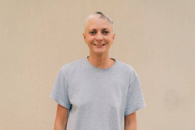 Genç bir kızda gerçek bir alopecia areata. Kel kafalı bir insan. Dağınık alopezi. Androjenik alopecia. Saç dökülmesi. Kafasında kellik var. Trikoloji. Yüksek kalite fotoğraf
