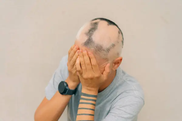 Genç bir kızda gerçek bir alopecia areata. Kel kafalı bir insan. Dağınık alopezi. Androjenik alopecia. Saç dökülmesi. Kafasında kellik var. Trikoloji. Yüksek kalite fotoğraf