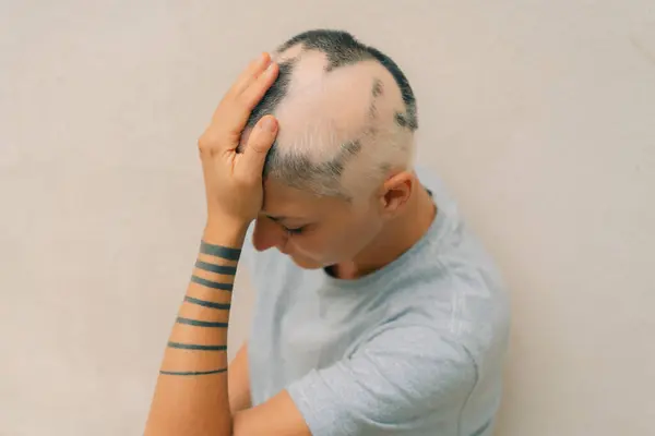 Echte Alopecia Areata Bei Einem Jungen Mädchen Eine Glatze Einer lizenzfreie Stockbilder