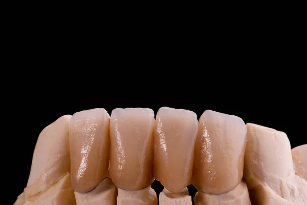 Sorriso Perfeito Melhorando Estética Dentária Com Coroas — Fotografia de Stock