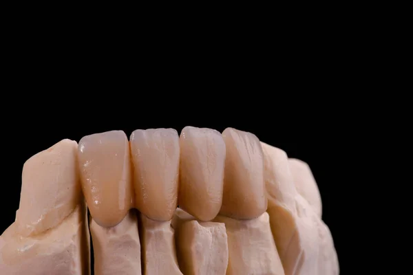 Perfect Smile Enhancing Dental Aesthetics Crowns — Stock Photo, Image