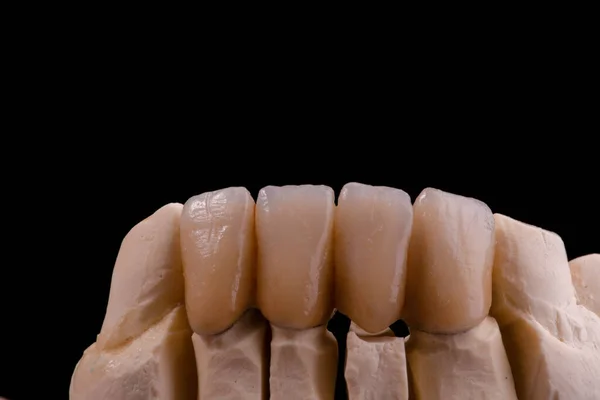 完璧な笑顔 クラウンで歯科美学を強化する — ストック写真