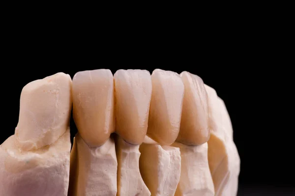 完璧な笑顔 クラウンで歯科美学を強化する — ストック写真