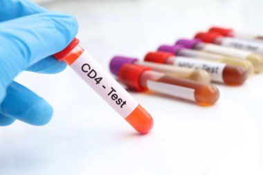 Kanda anormallik olup olmadığına bakmak için CD4 testi laboratuvarda analiz edilecek kan örneği, test tüpünde kan.