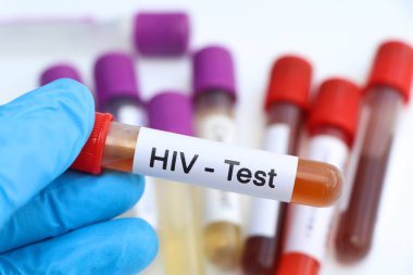 Kandaki anormallikleri araştırmak için HIV testi laboratuvarda analiz edilecek kan örneği, test tüpünde kan.