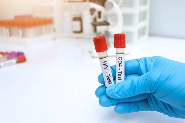 HIV test and CD4 test to look for abnormalities from blood,  blood sample to analyze in the laboratory, blood in test tube