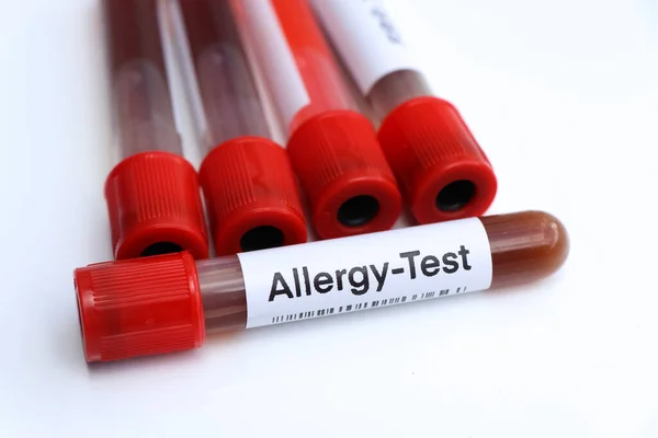 Allergy test to look for abnormalities from blood,  blood sample to analyze in the laboratory, blood in test tube