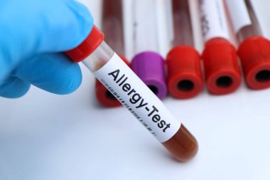 Kandaki anormallikleri araştırmak için alerji testi laboratuvarda analiz edilecek kan örneği, test tüpünde kan.