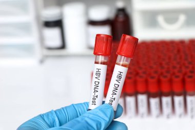  Kandaki anormallikleri araştırmak için HBV DNA testi laboratuvarda analiz etmek için kan örneği, test tüpünde kan.